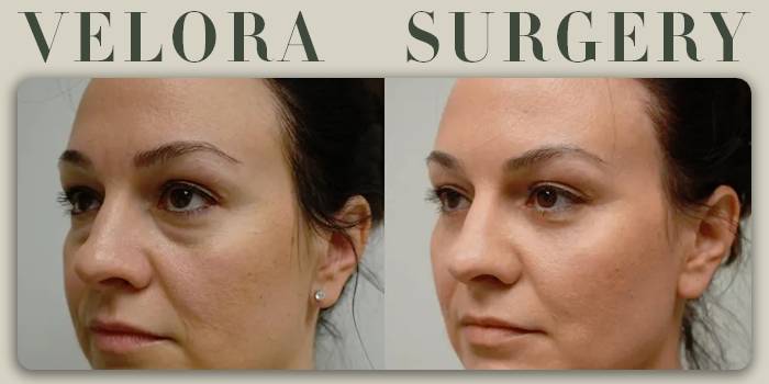 جراحی پلک پایین (Lower Blepharoplasty) برای چه کسانی مناسب است؟